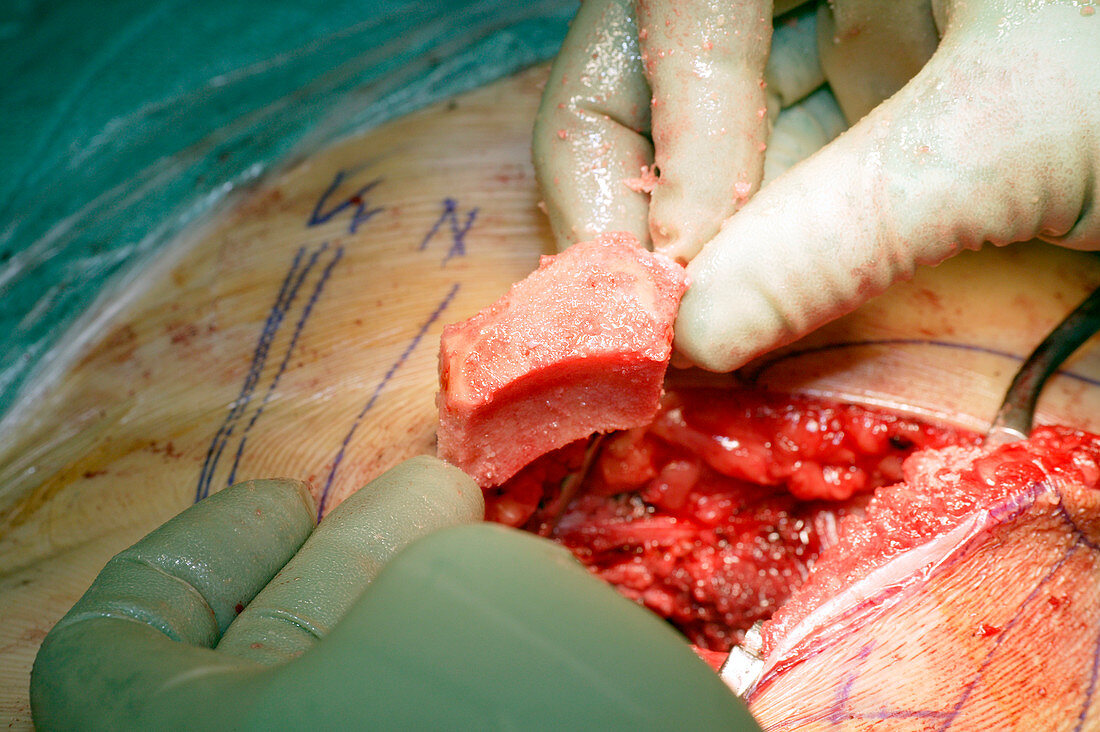 Surgery to remove a tumour in the pelvis