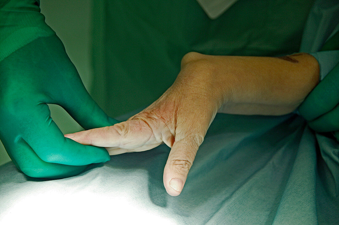 Carpal tunnel syndrome surgery