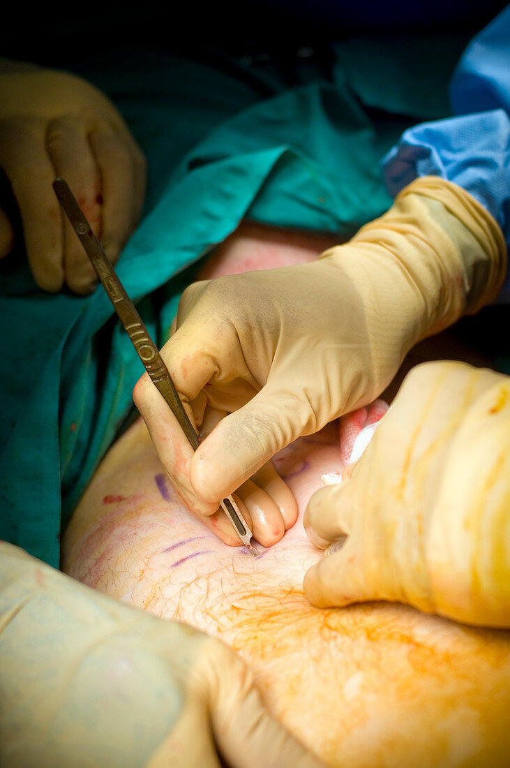 Varicose vein surgery