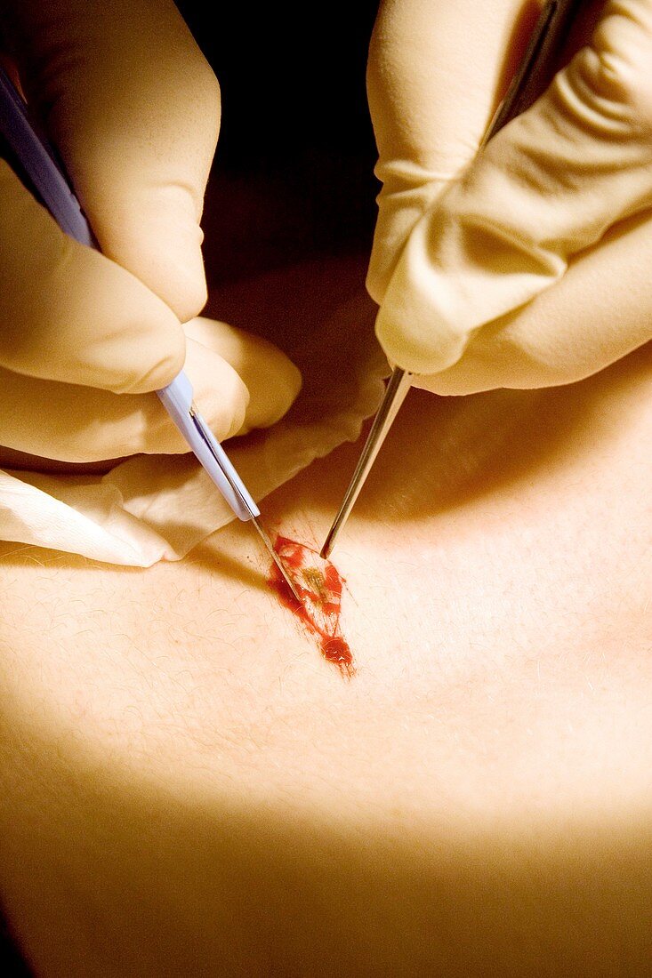 Biopsy procedure