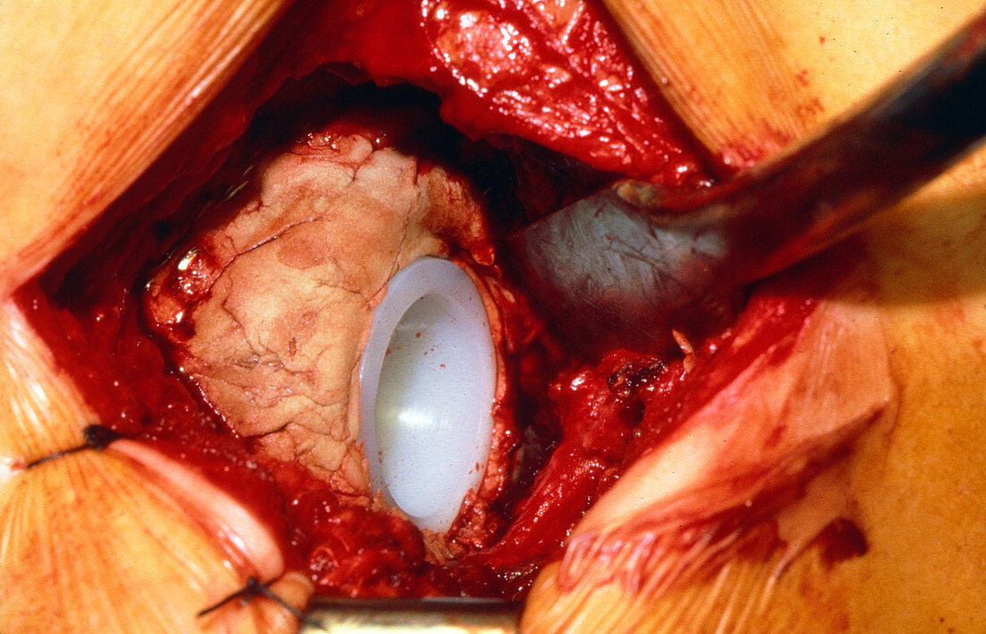 Hip replacement surgery: plastic hip socket