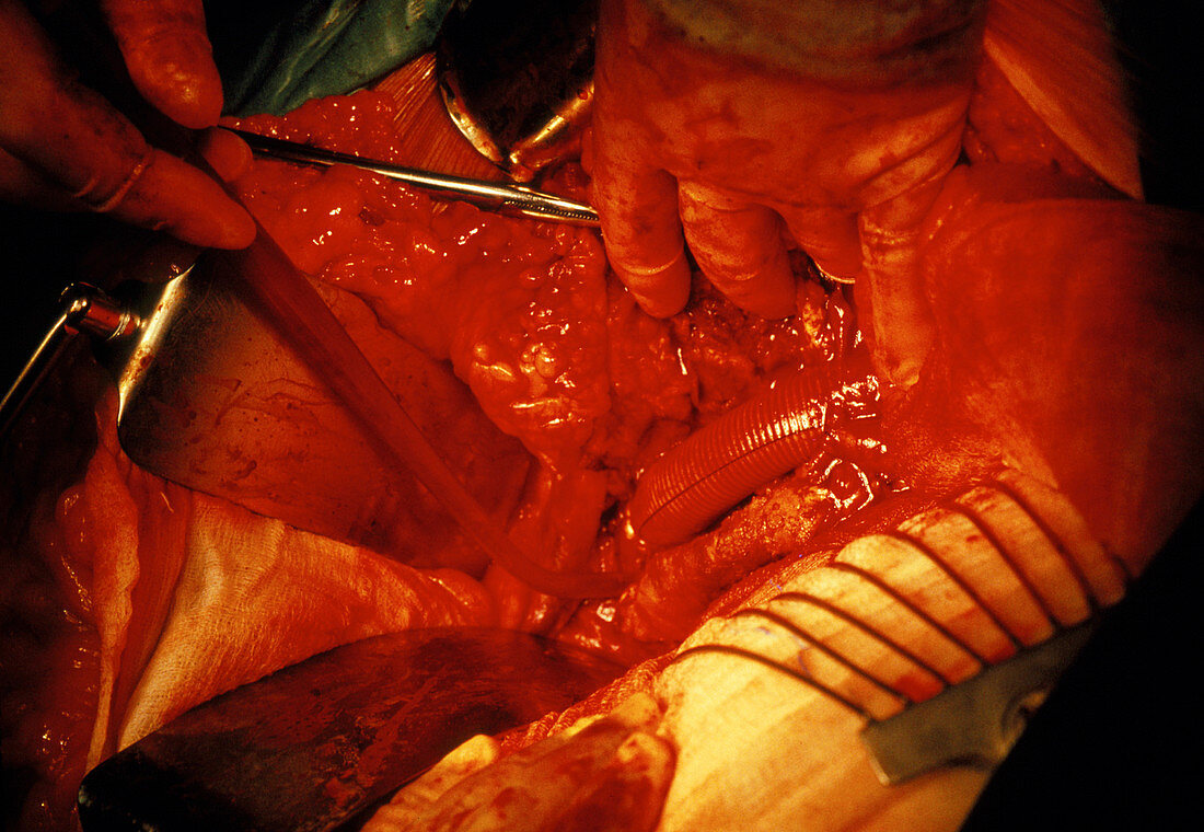 Surgery to repair aortic aneurysm