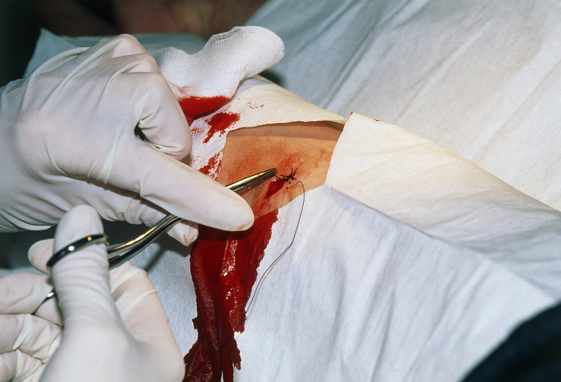 Stitching a surgical wound on a woman's arm