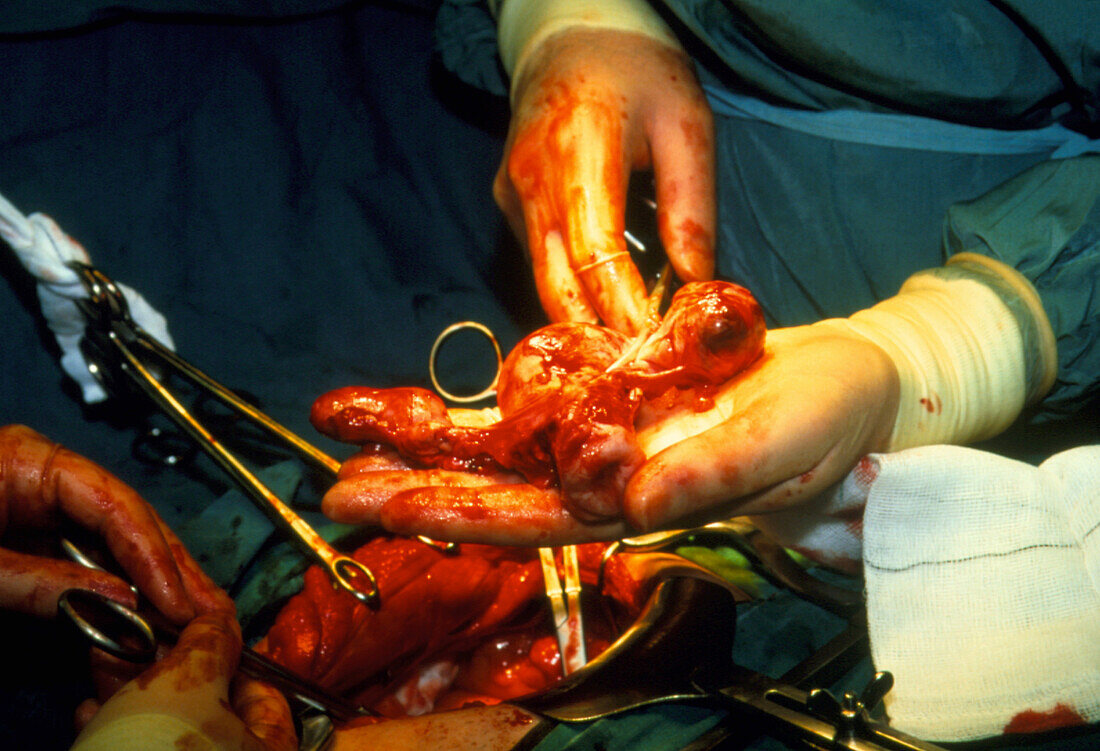 Surgeon holding woman's uterus after hysterectomy