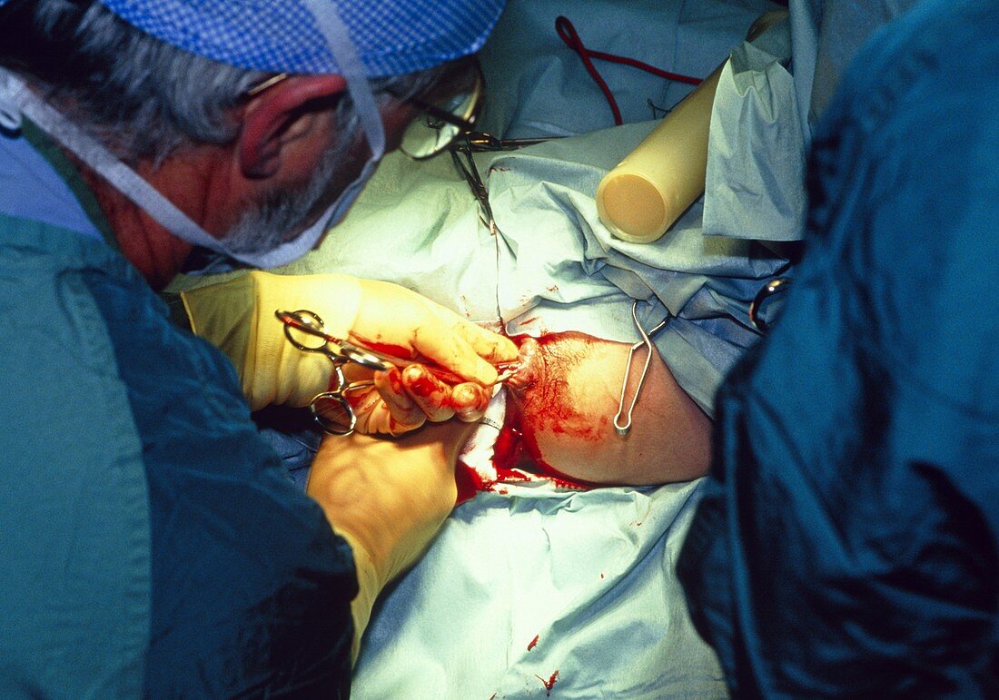 View of a surgeon operating on anal polyps