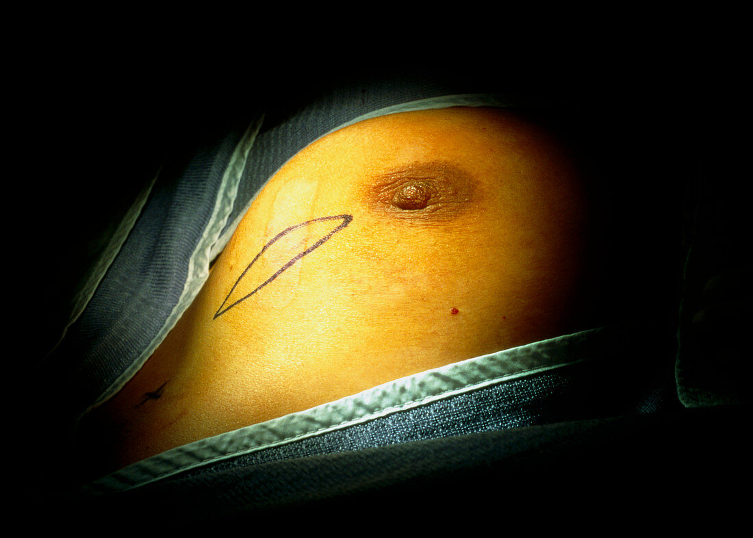 Breast during surgery with cancerous areas marked