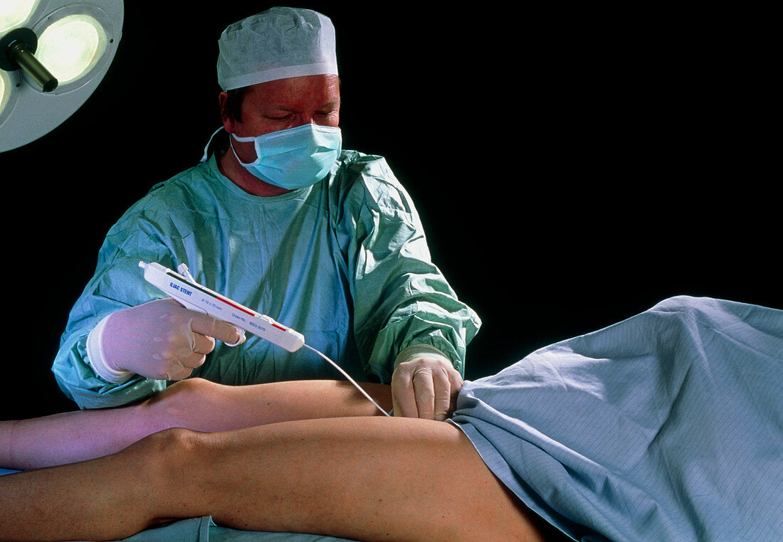 Surgeon placing iliac stent in woman's leg