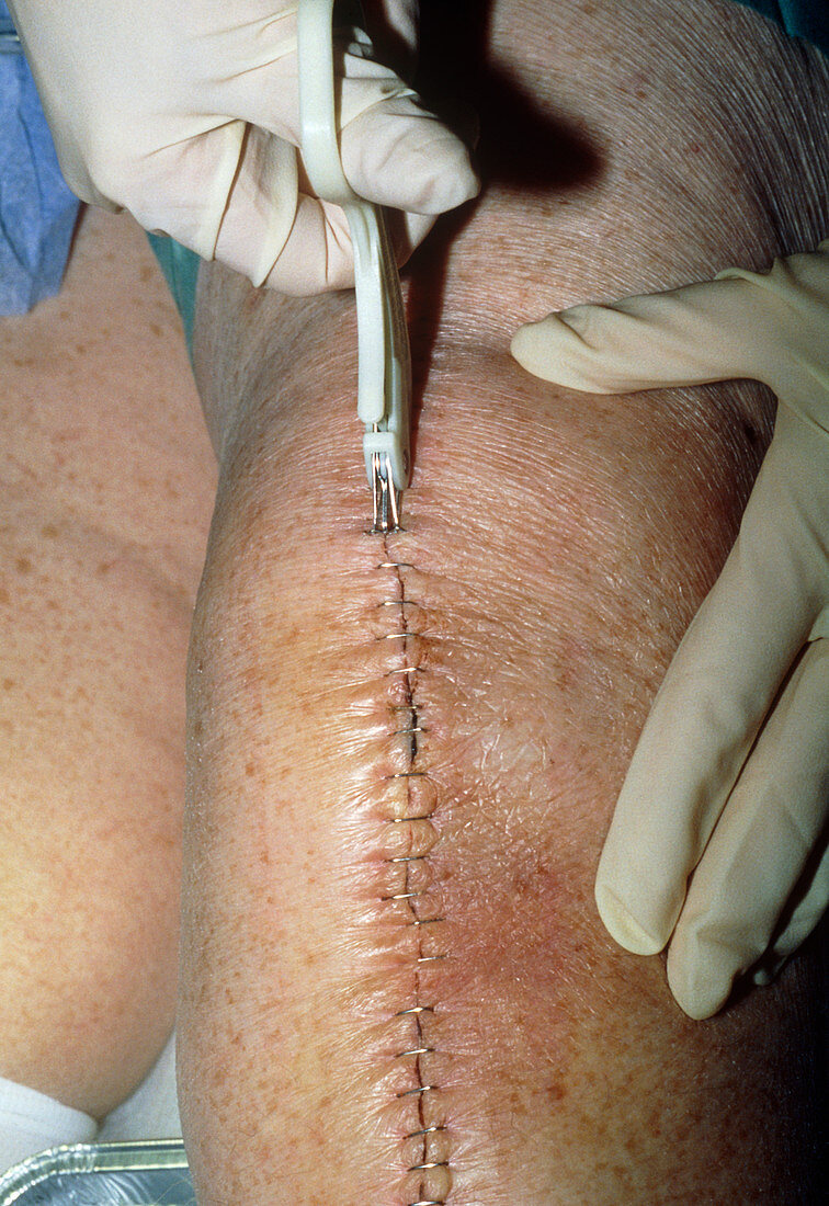 Steel suture removal
