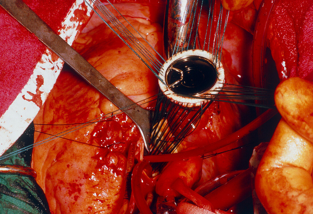 Aortic valve replacement