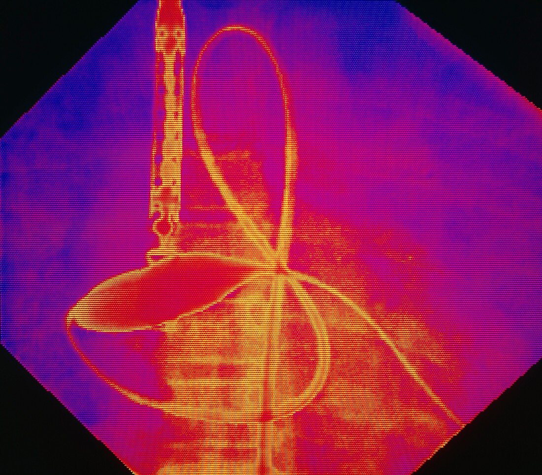Coloured X-ray of cardiac angioplasty in progress