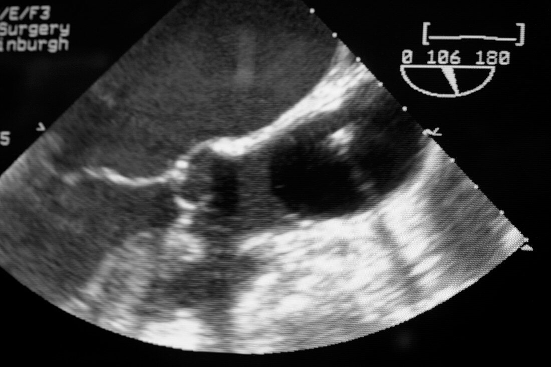 Heart valve surgery,ultrasound scan