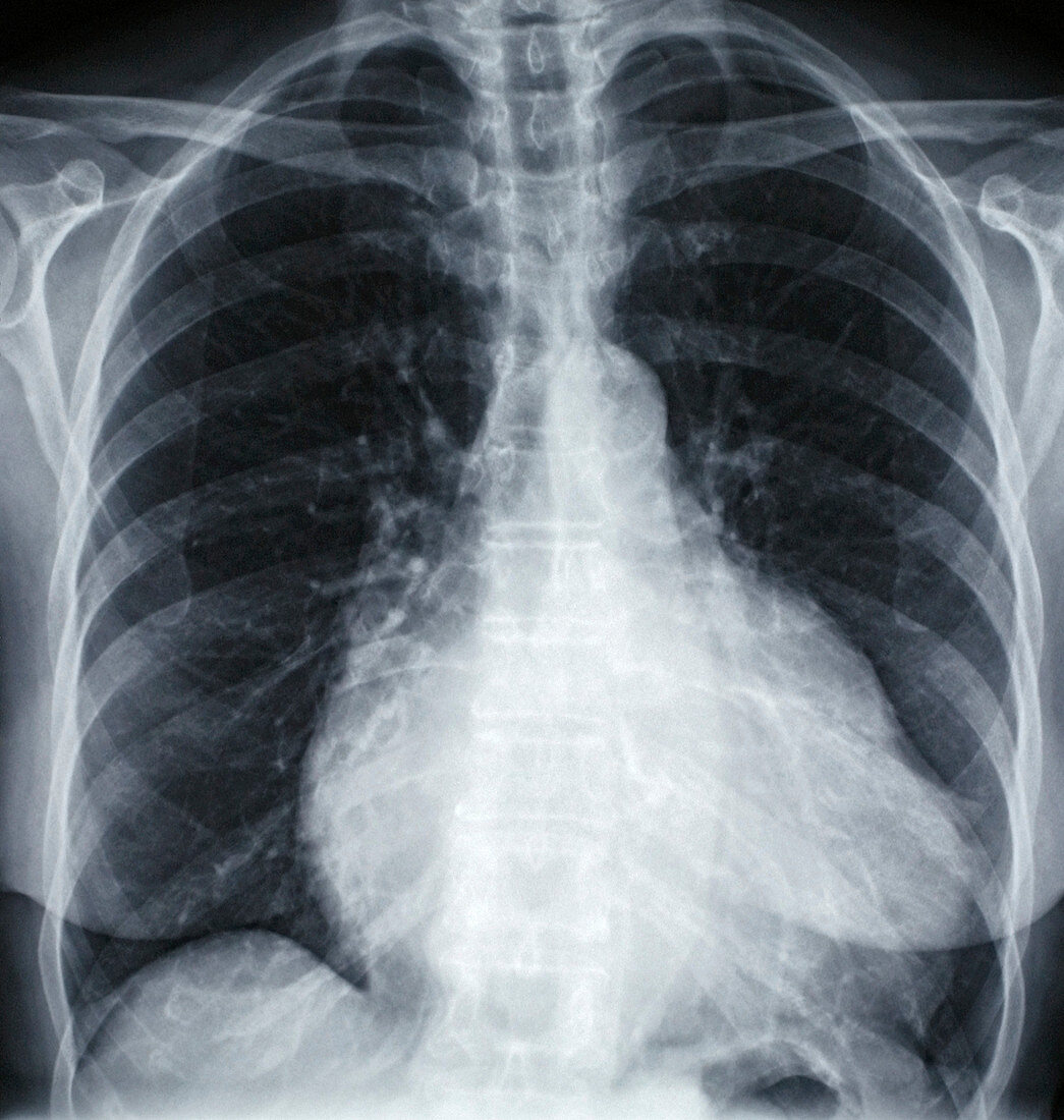 Heart prior to valve replacement,X-ray