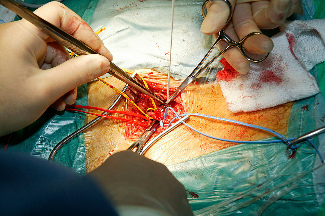 Heart surgery