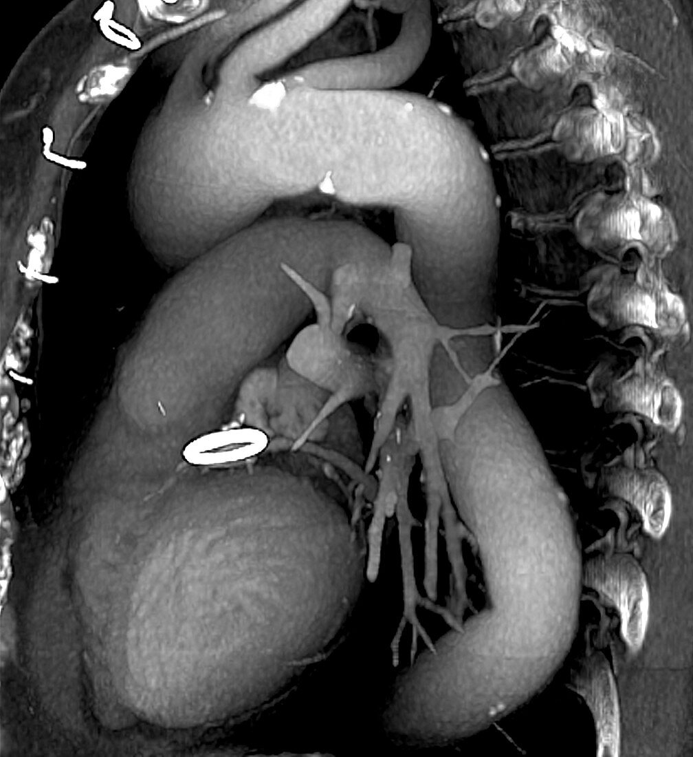 Prosthetic heart valve,3D CT scan