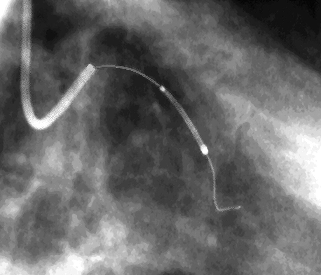 Coronary angioplasty,X-ray