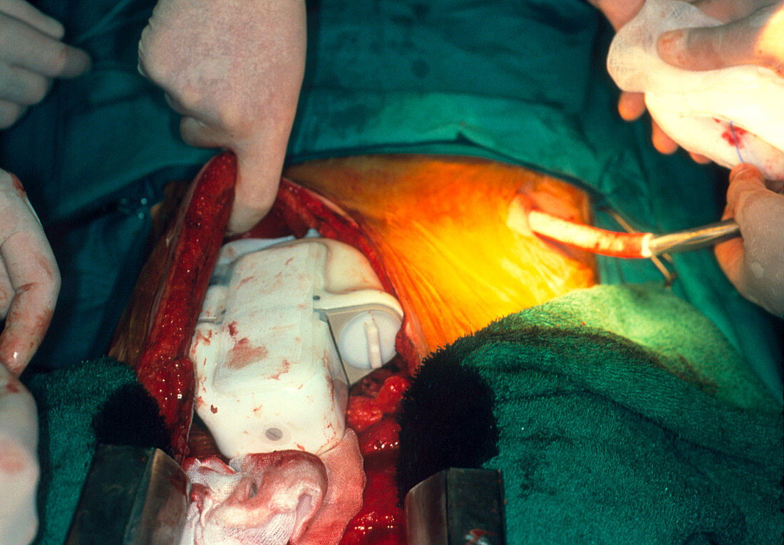Placing artificial heart in abdomen during surgery