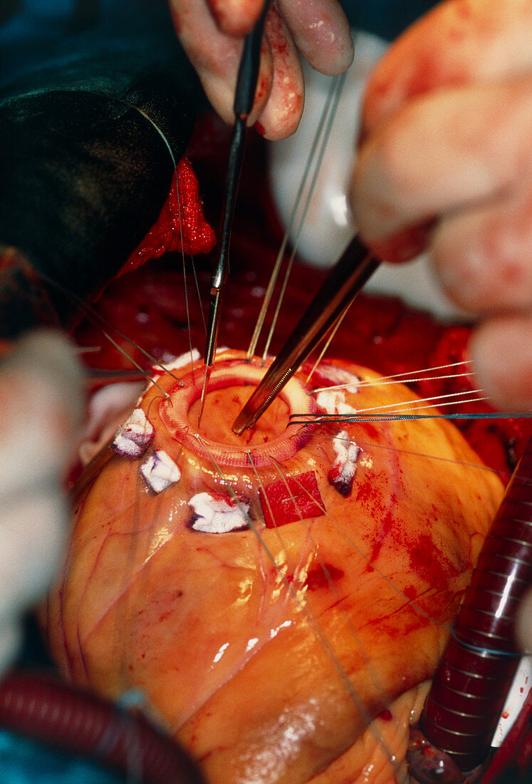Cutting a heart ventricle in implant surgery