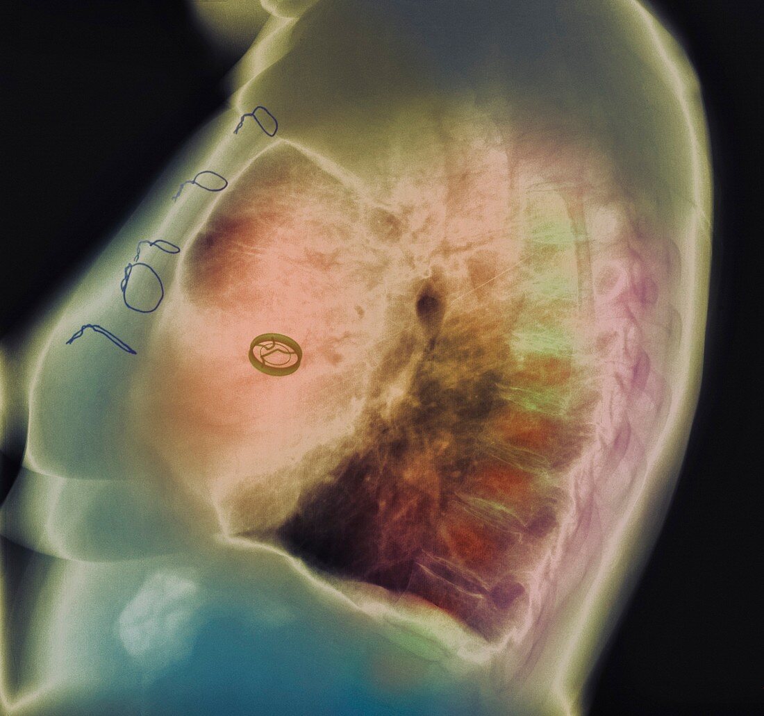 Heart valve replacement,X-ray