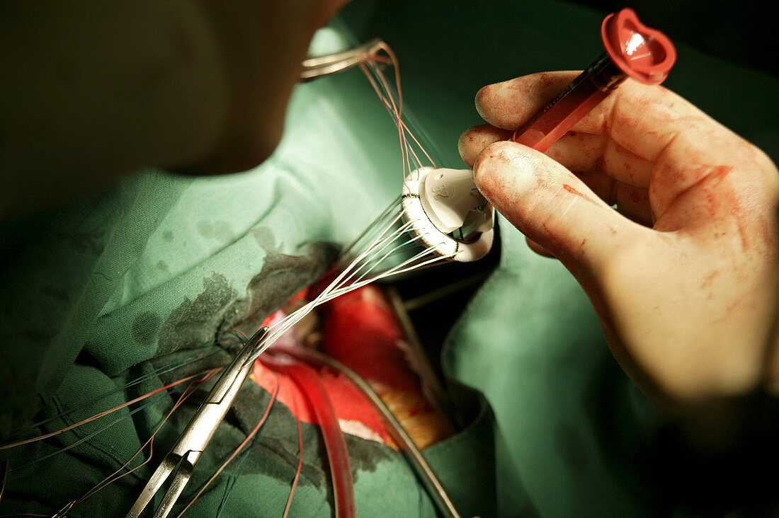 Heart valve surgery