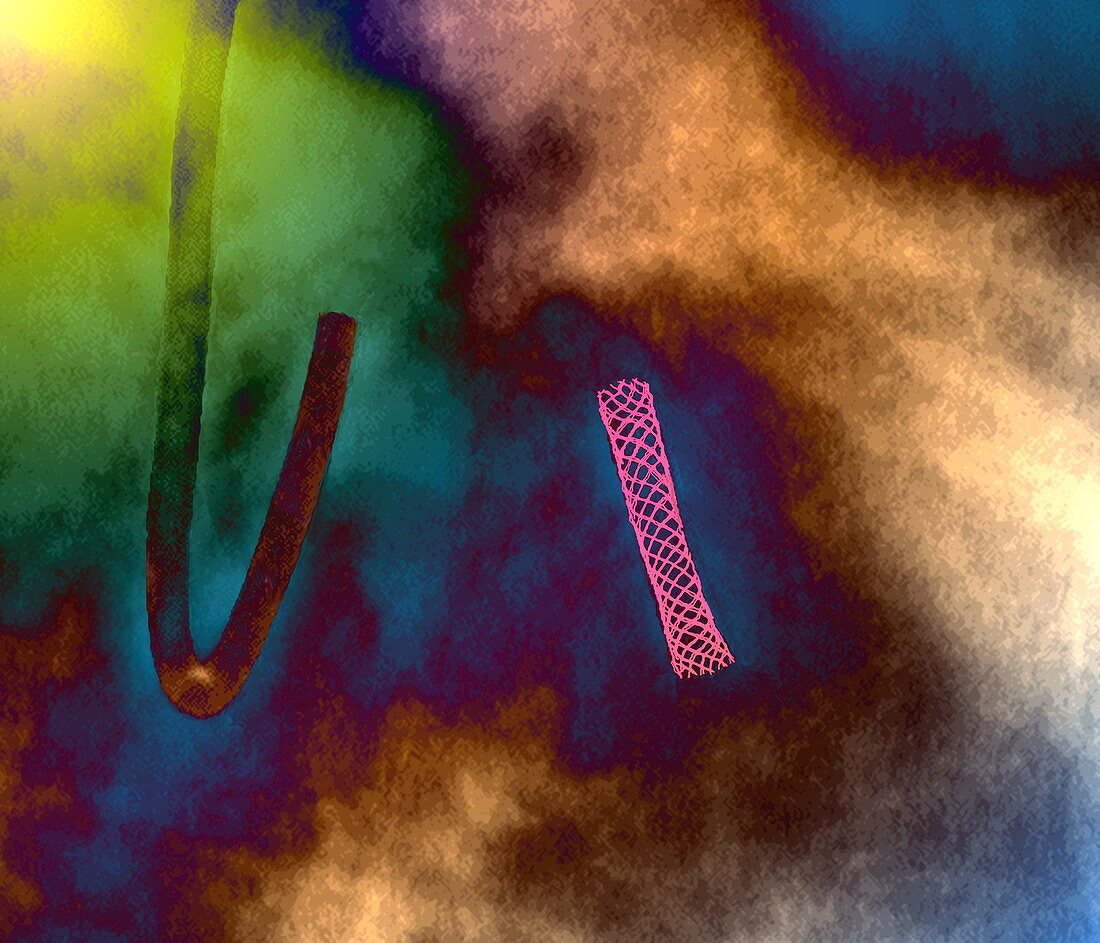 Coronary angioplasty,X-ray