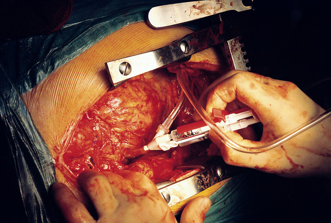 Heart bypass surgery