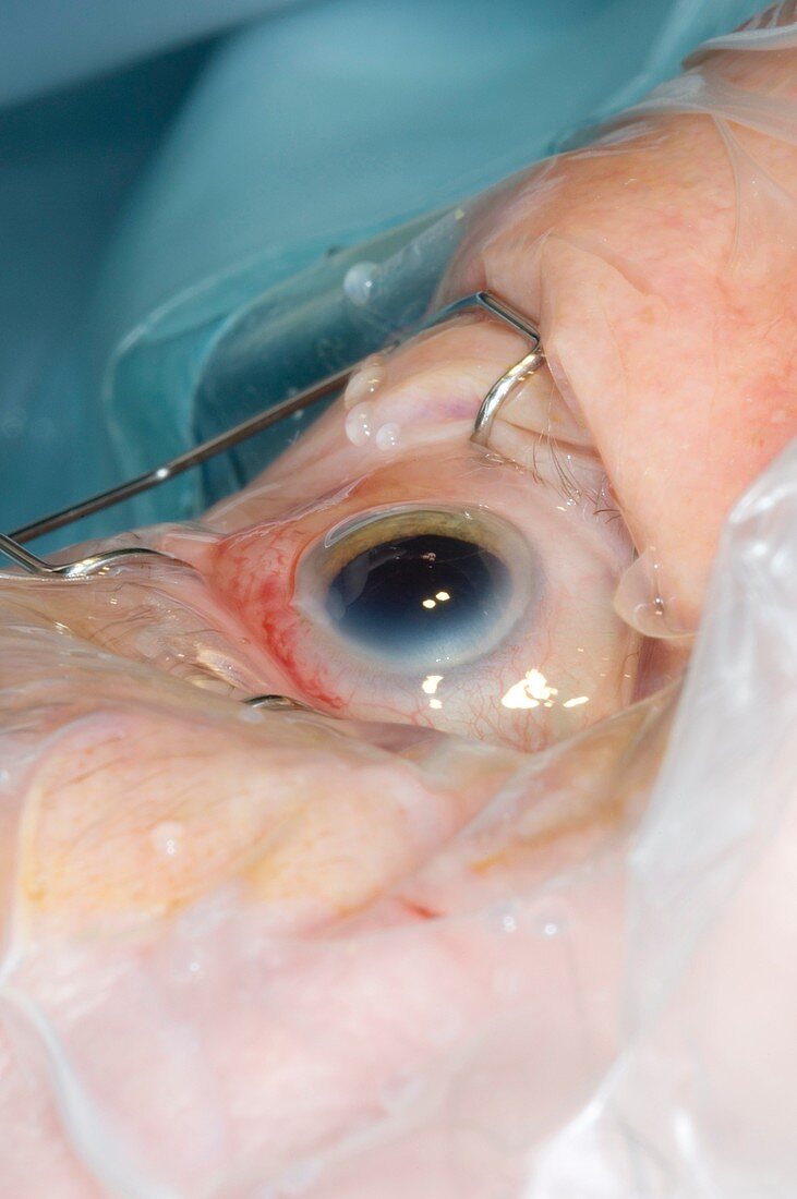 Cataract surgery