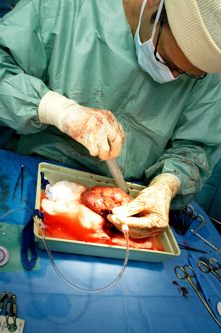 Kidney transplant