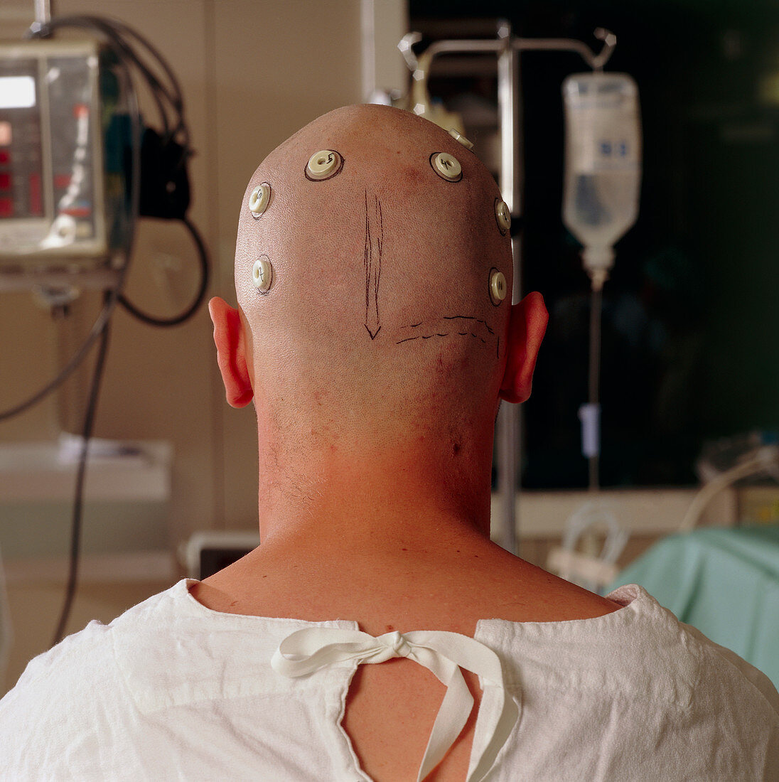 Neurosurgery patient with head map markers