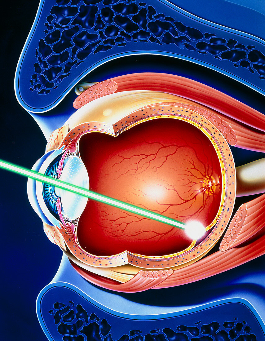 Artwork of laser surgery on detached retina