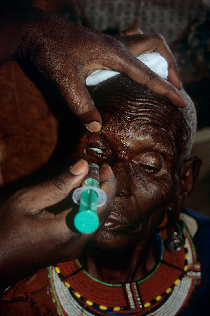 Eye surgery,Kenya