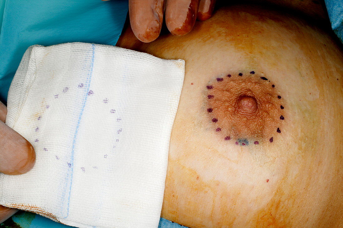 Nipple reconstruction surgery