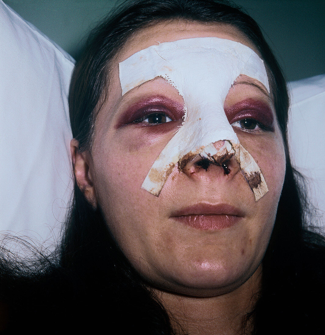 Woman after rhinoplasty