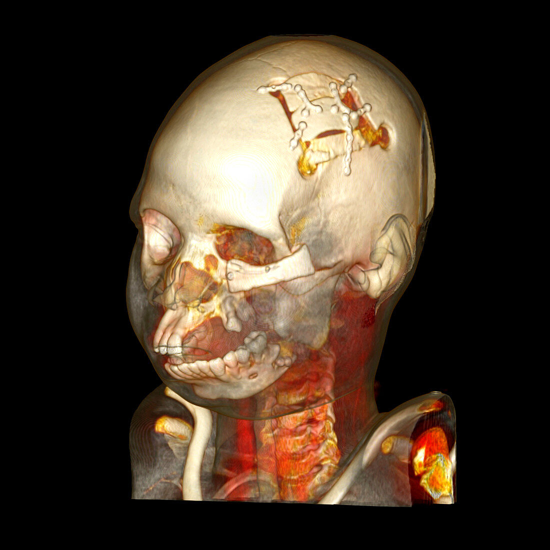 Facial reconstruction,CT scan