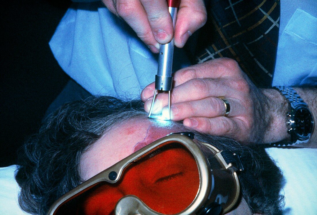 Argon laser treatment of port-wine stains