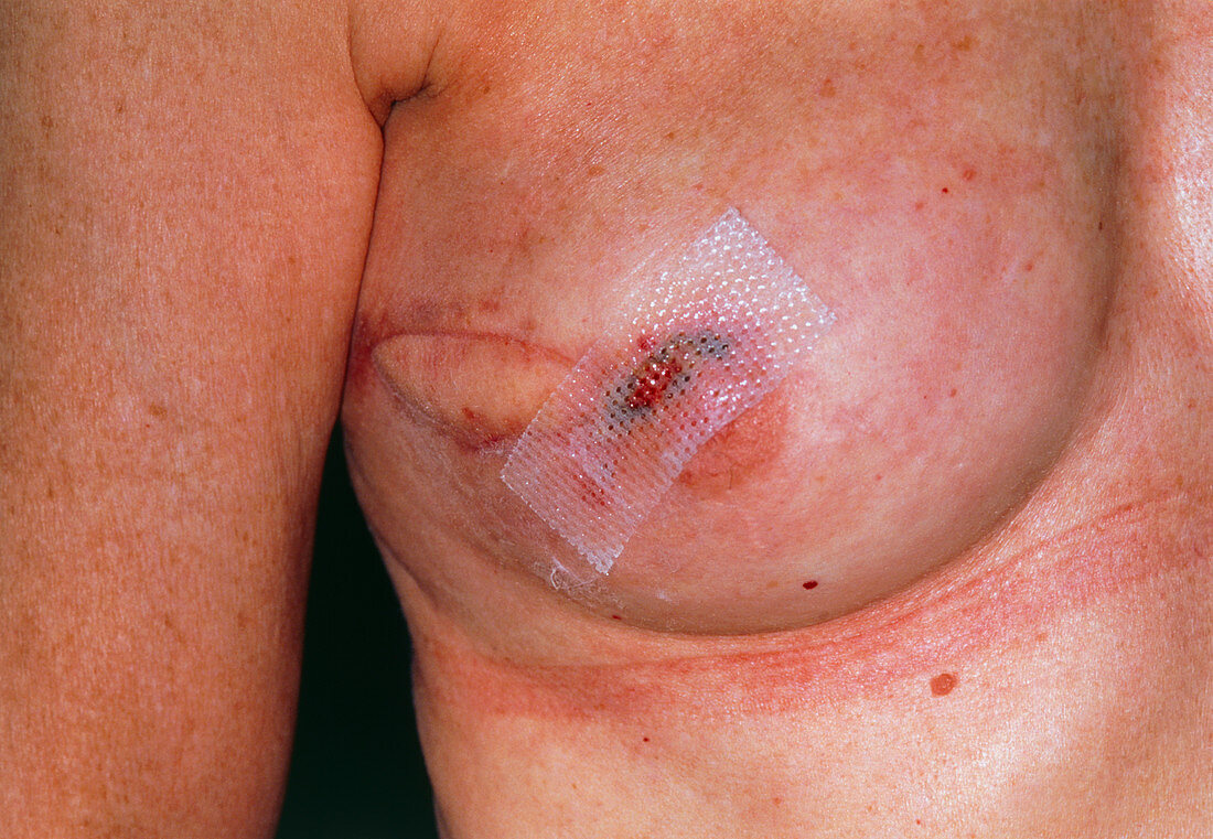 Breast reconstruction following tumour excision