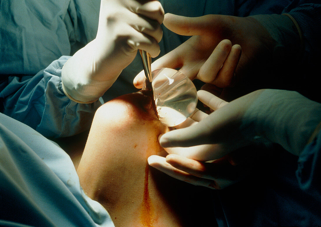 View of surgeons implanting a breast prothesis