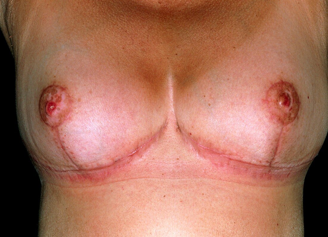 Scars after breast reduction