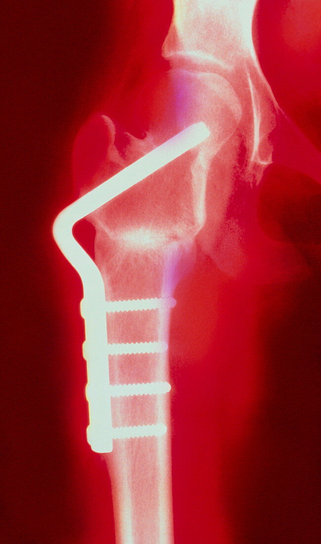 Coloured X-ray of femoral osteotomy