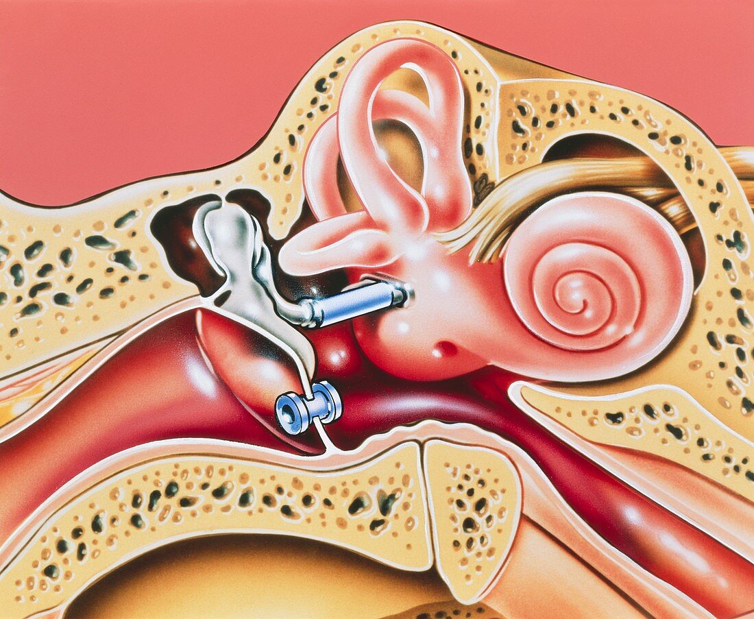 Artwork of prosthetic stapes in middle ear