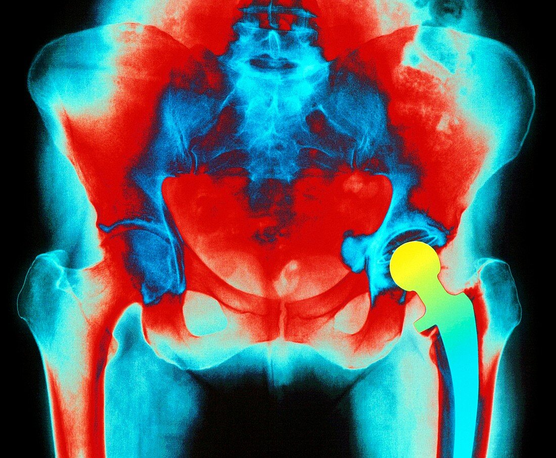 Coloured X-ray of an artificial hip joint