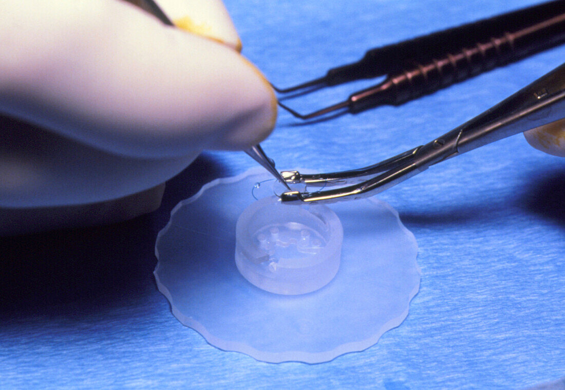 View of forceps holding a prosthetic eye lens