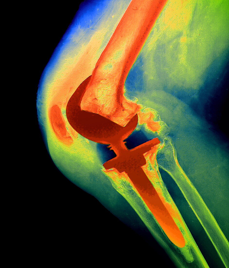 Knee replacement,X-ray