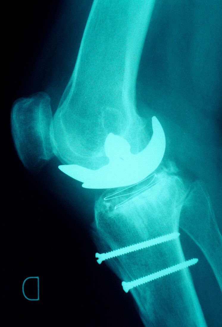 Prosthetic knee