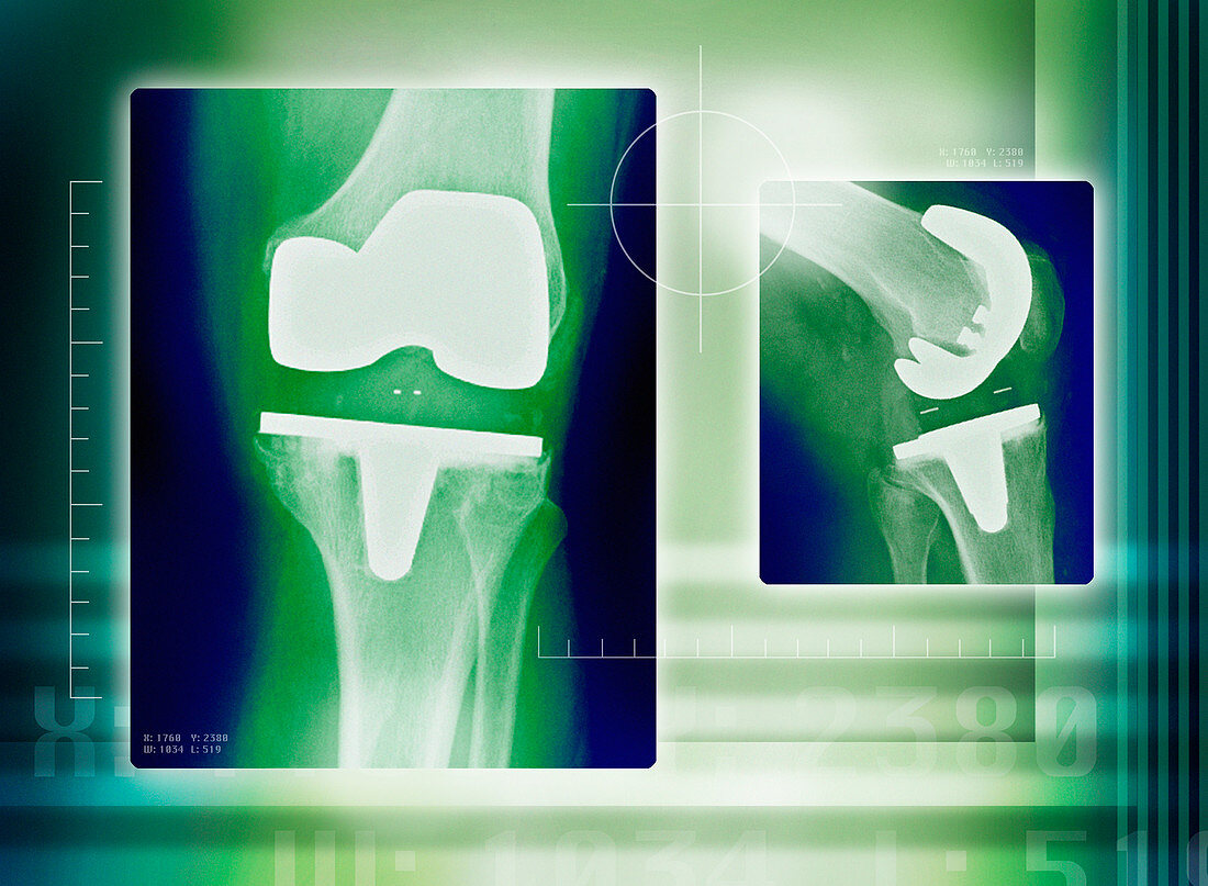 Knee replacement,X-rays