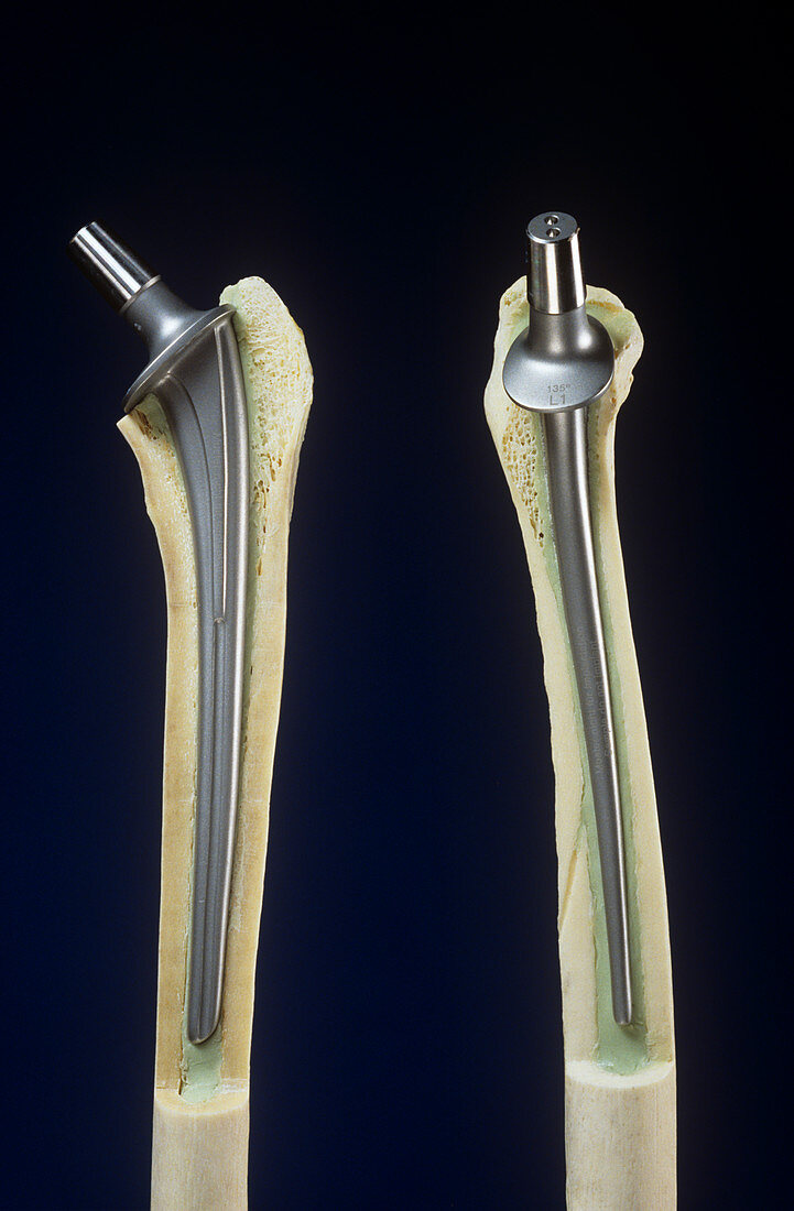 Artificial hip joints