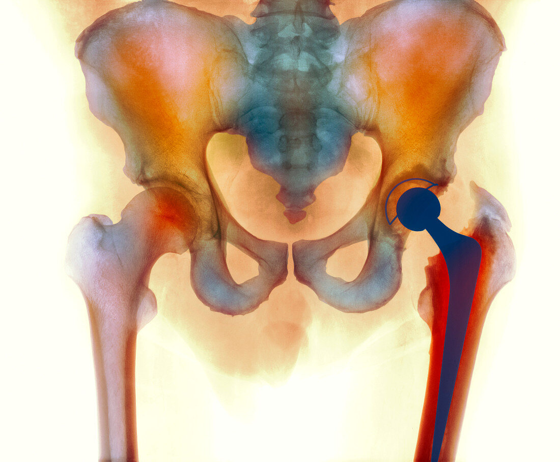 Hip joint replacement,X-ray