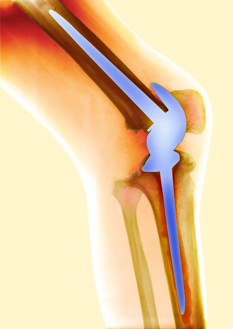 Knee replacement,X-ray