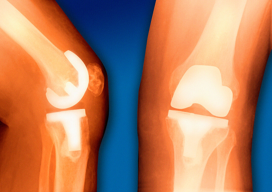 Prosthetic knee joint,coloured X-ray
