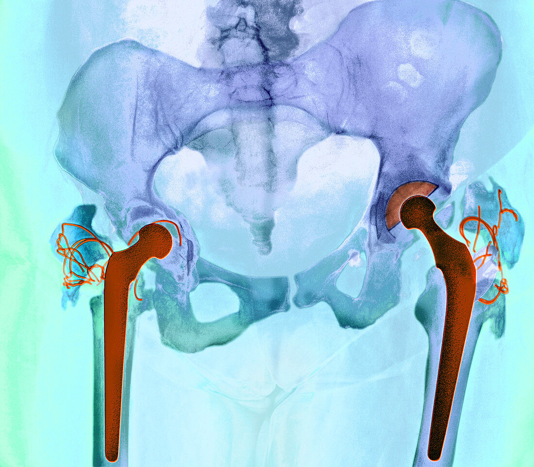 Failed total hip replacement,X-ray