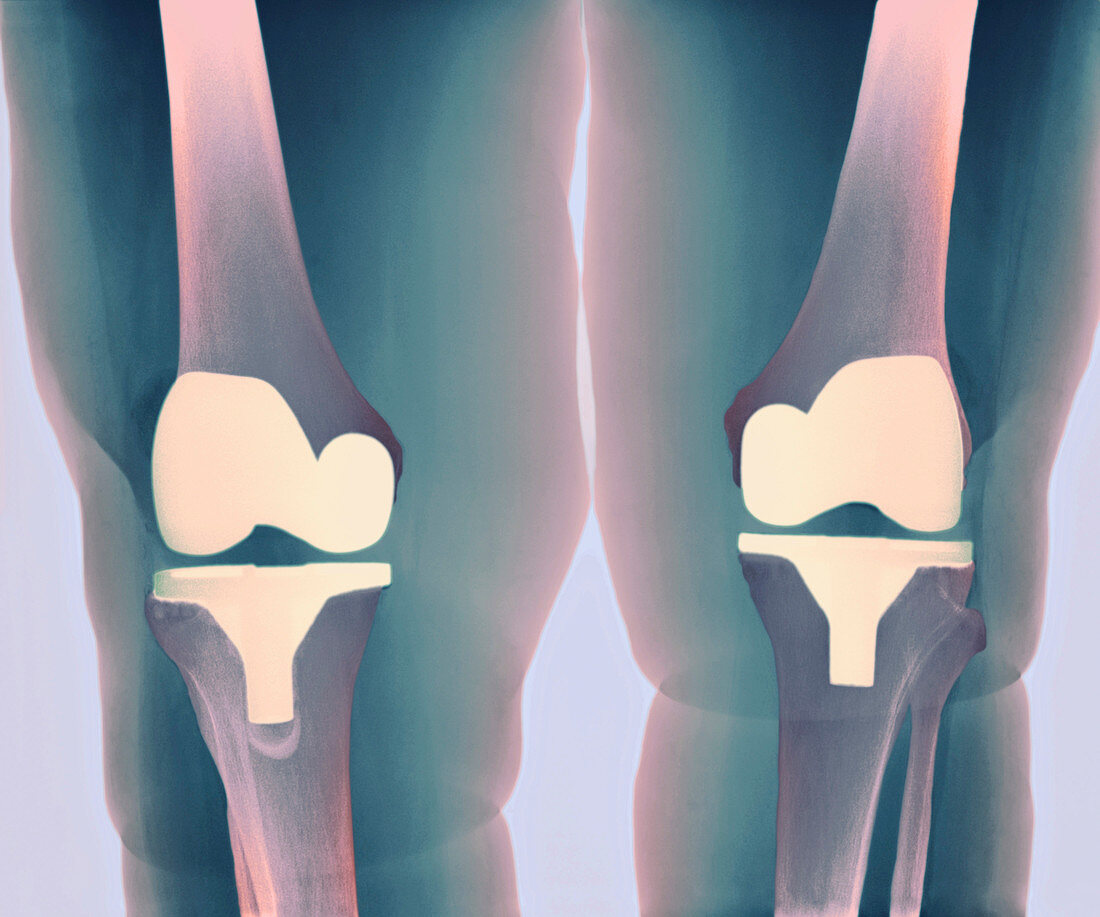 Prosthetic knee joints,X-ray